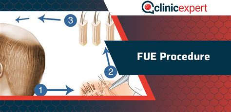 FUE Procedure | ClinicExpert