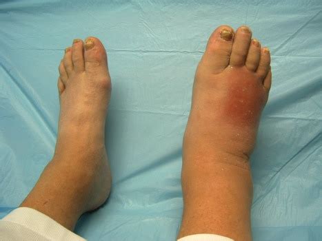 Charcot Foot: Causes, Symptom, Treatment & Complication » How To Relief