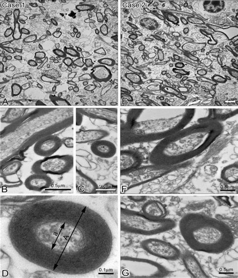 Electron micrographs of myelinated axons in white matter below STG ...