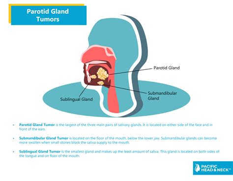 Parotid Gland Tumor Ultrasound