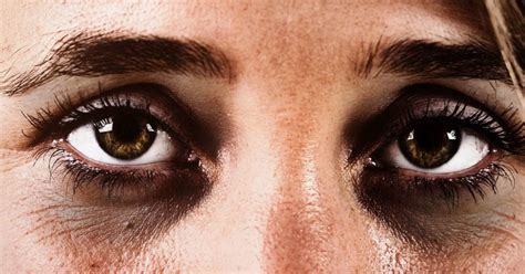 Dark circles under the eyes: Causes and treatments