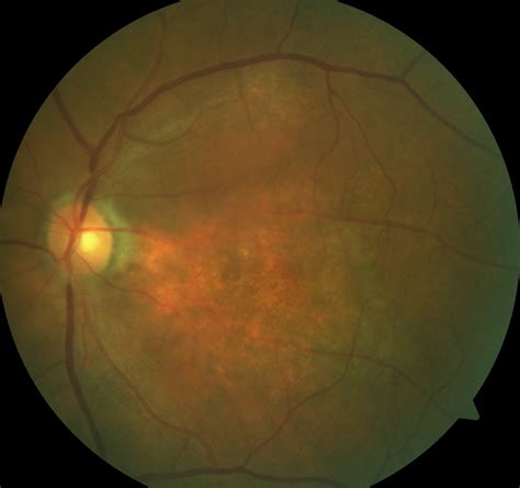 Choroidal hemangioma – the retina vault