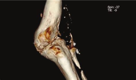 Ten days after arthrodesis. | Download Scientific Diagram