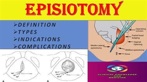 Episiotomy- Definition, Indications, Types, Complications - YouTube