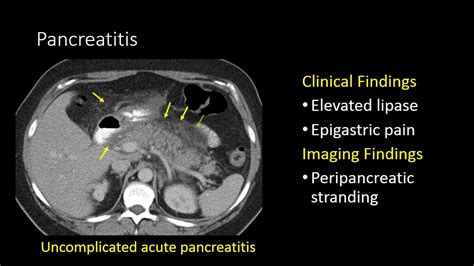 GI Imaging - Pancreatitis - YouTube