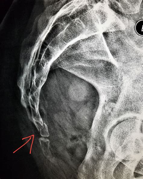 #Pelvic #Xray shows a #tail #bone (#coccyx) #fracture in a #woman who # ...