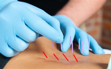 What is Dry Needling? | Aspire Hospital