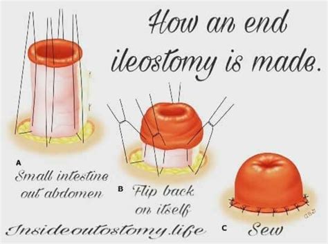 Ileostomy Vs Colostomy Colostomy Ileostomy Ostomy