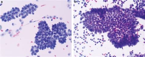 Benign mesothelial cells with highly irregular nuclear membranes and ...