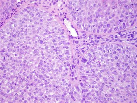 Desmoplastic Trichilemmoma | Dermatopathology