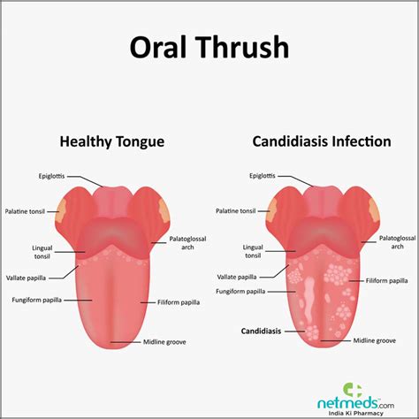 How To Cure An Oral Yeast Infection - Buildingrelationship21