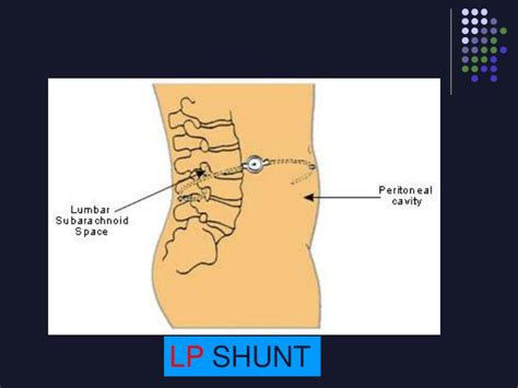 PPT - VP Shunts PowerPoint Presentation - ID:3387790