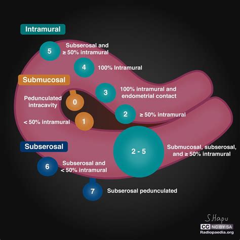 Uterine leiomyoma (fibroid) classification system (illustration ...