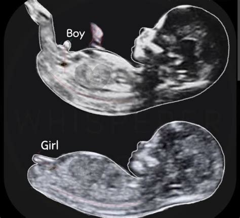 Gender Imaging Ultrasound - Ultrasound Services - Fetal Fotos 307 ...