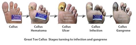 Diabetic Gangrene stages-Great Toe Base - Podiatry Doctor