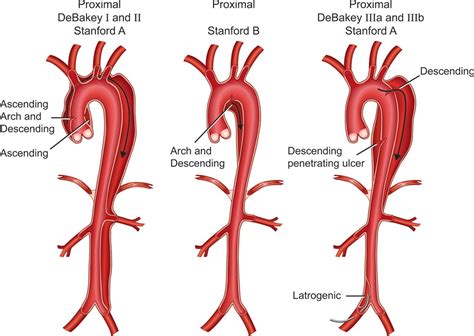 Management of acute aortic syndromes