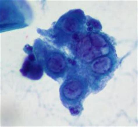 Pap smear abnormal cells | General center | SteadyHealth.com