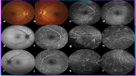 Fundus Fluorescein Angiography FFA Testing - YouTube