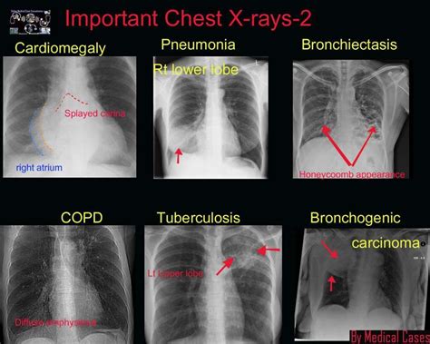 chest x - rays are shown with different types of thoraches and their ...