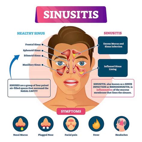 6 Common Symptoms of Chronic Sinusitis | Chronic sinusitis, Sinus ...