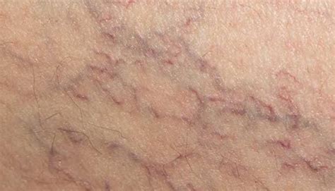 Veins and Vascular Lesions - Sydney Cosmetic Specialists