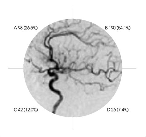 Classification of anterior communicating artery aneurysms according to ...