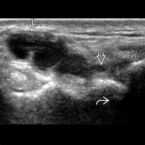 Ganglion Cyst | Radiology Key