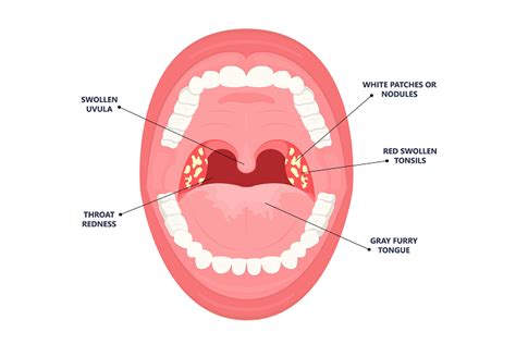 Do You Need to Worry About Tonsil Stones?