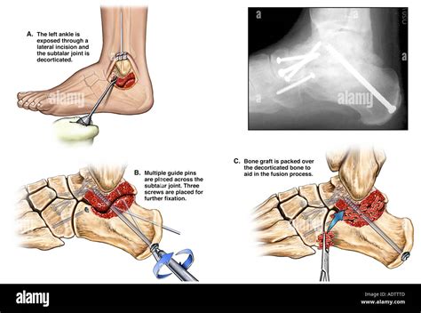 Fractured Ankle Joint with Triple Arthrodesis Fusion Surgery Stock ...