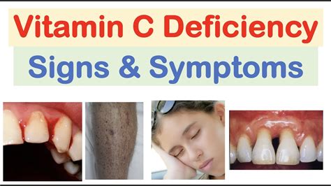 Vitamin C Deficiency Signs & Symptoms, Consequences (& Why They Occur ...