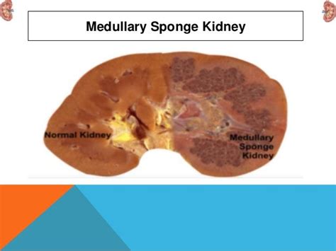 Medullary sponge kidney (msk)