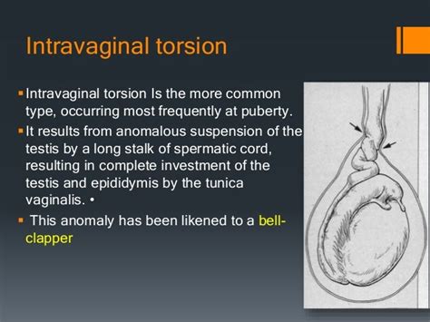 TESTICLULAR TORSION