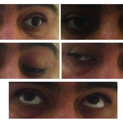 Neuro exam on day 1 of steroid treatment reveals right palpebral ptosis ...