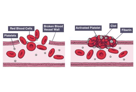 IGCSE Biology Notes: 2.62: Understand that Platelets are Involved in ...