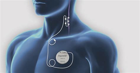 Vagus Nerve Stimulation (VNS) | Epilepsy Society