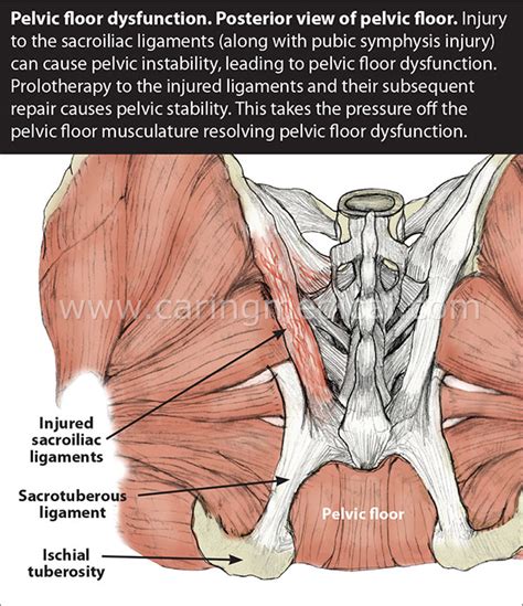 Ischial tuberosity pain syndrome treatment