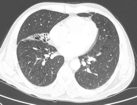 Right middle lobe syndrome | Radiology Case | Radiopaedia.org