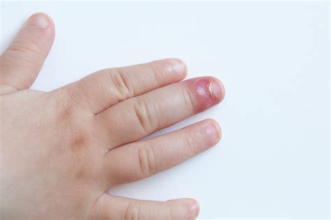 Paronychia - Skin Infection Around the Nails | familydoctor.org