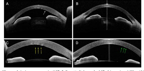 Figure 2 from A Case with Corneal Decompensation in Pseudoexfoliation ...