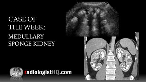 Case of the Week: Medullary Sponge Kidney (Ultrasound & CT) - YouTube