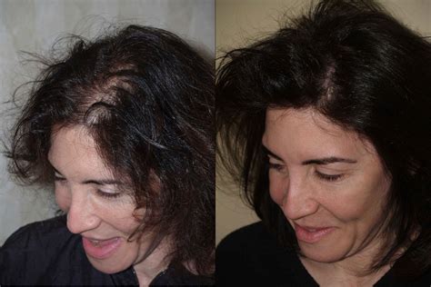 Hair Transplants for Women photos | Miami, FL | Patient58205