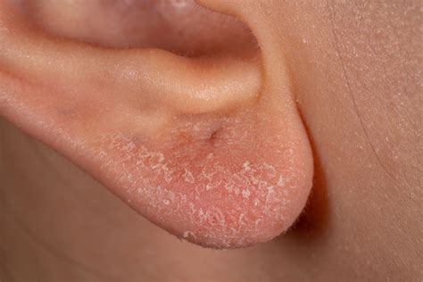 Ear Eczema: Causes, Symptoms, Treatment and Prevention