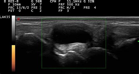 Ganglion Cyst Ultrasound