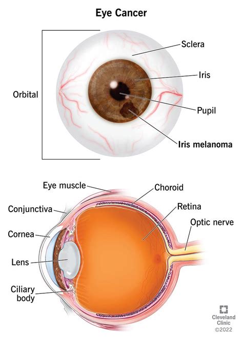 Eye Cancer: Symptoms, Types & Treatment