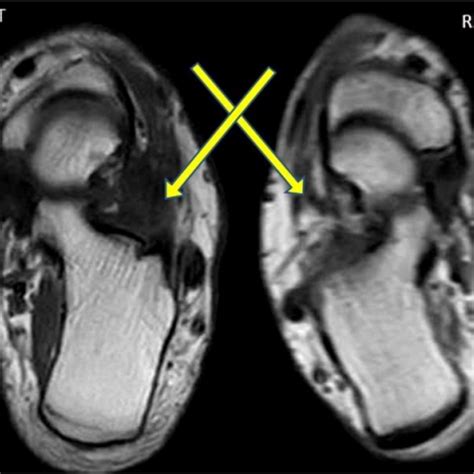 Sinus Tarsi Mri