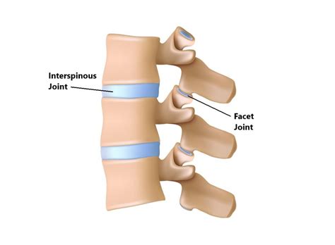 Facet Joint Injuries - My Family Physio