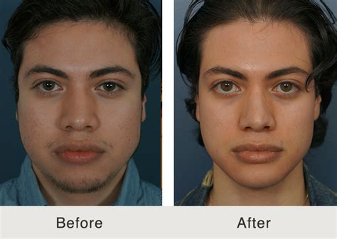 Nose Jobs and Rhinoplasties for Wide Noses - Carolina Facial Plastics