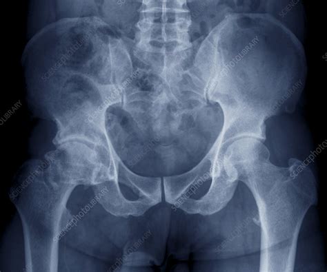 Osteoarthritis of the hip, X-ray - Stock Image - C009/5441 - Science ...