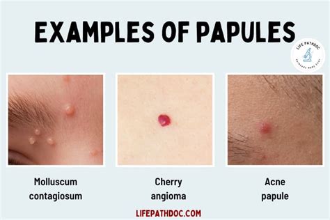 Papule vs Pustule vs Nodule: Pictures, Differences, and Causes