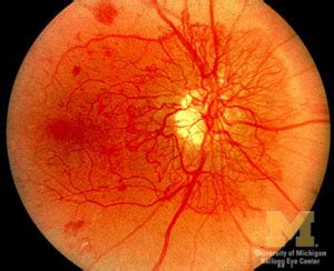 Retinal Neovascularization : Ophthalmoscopic Abnormalities : The Eyes ...